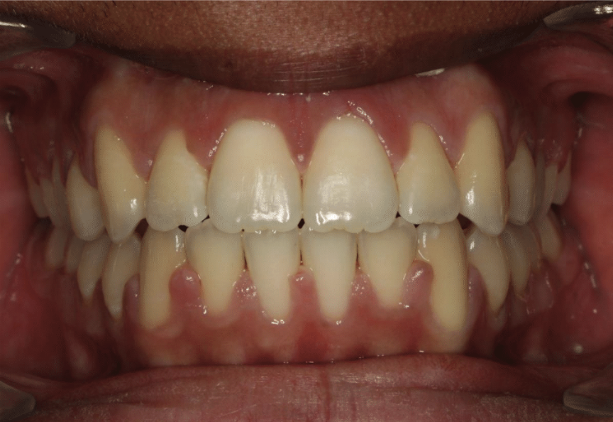 Comprehensive open bite – Patient 3 after