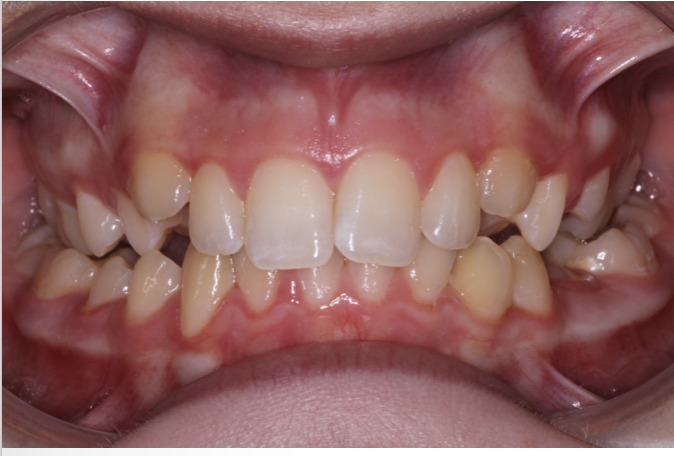 Crossbite correction – Patient 5 before