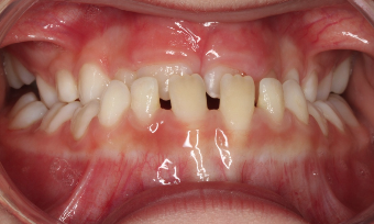 Phase I underbite – Patient 3 before