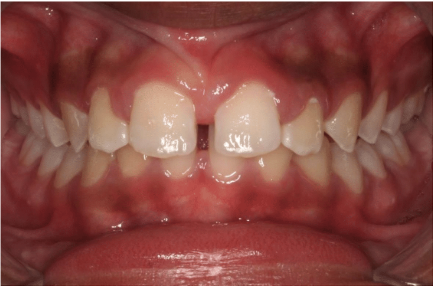 Comprehensive spacing – Patient 1 before