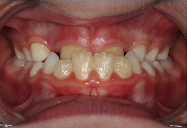 Comprehensive underbite – Patient 4 before