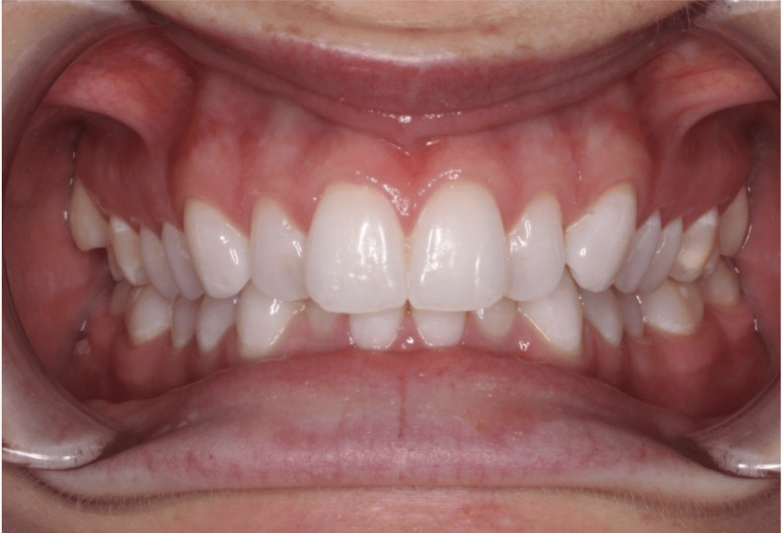 Comprehensive deep bite – Patient 2 before