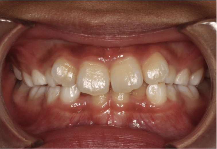 Comprehensive crowding – Patient 6 before
