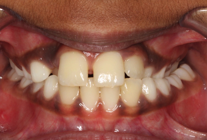Before treatment