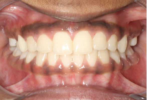 Crossbite correction – Patient 1 after