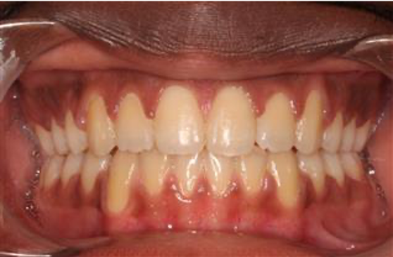Comprehensive open bite – Patient 6 after
