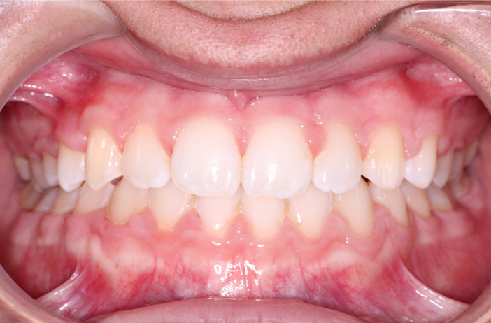 Comprehensive underbite – Patient 7 after