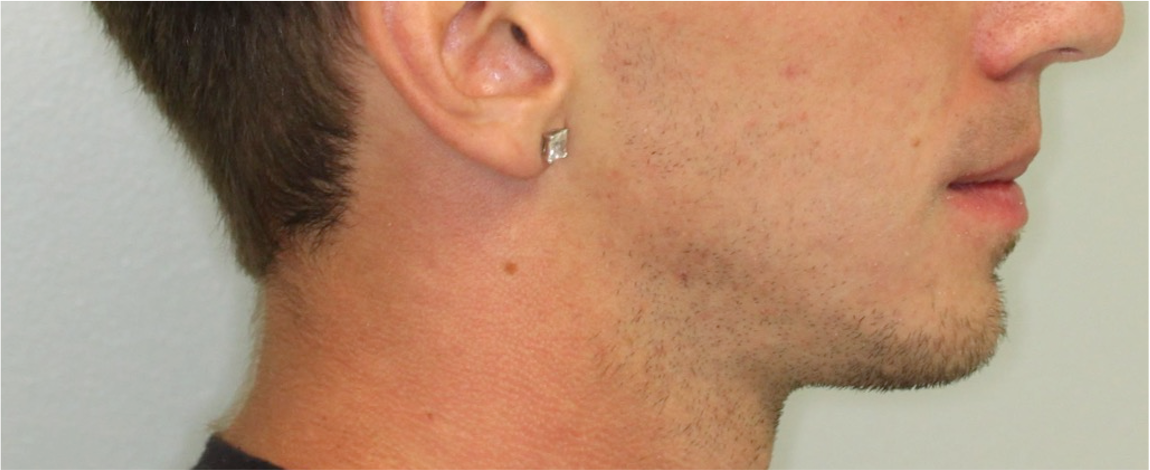Comprehensive surgical – Patient 1 after
