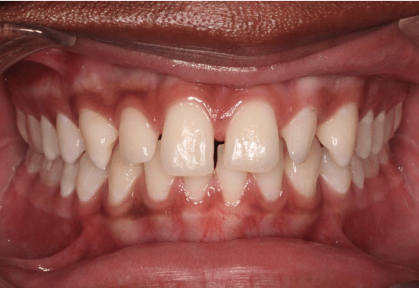 Comprehensive spacing – Patient 8 before
