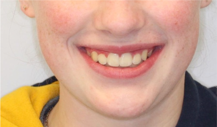 Comprehensive protrusion – Patient 2 after