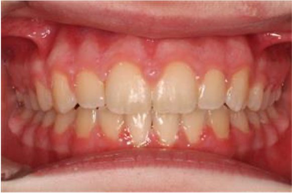 Comprehensive open bite – Patient 8 after