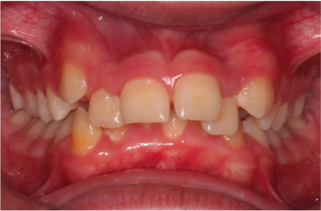 Comprehensive protrusion – Patient 7 before