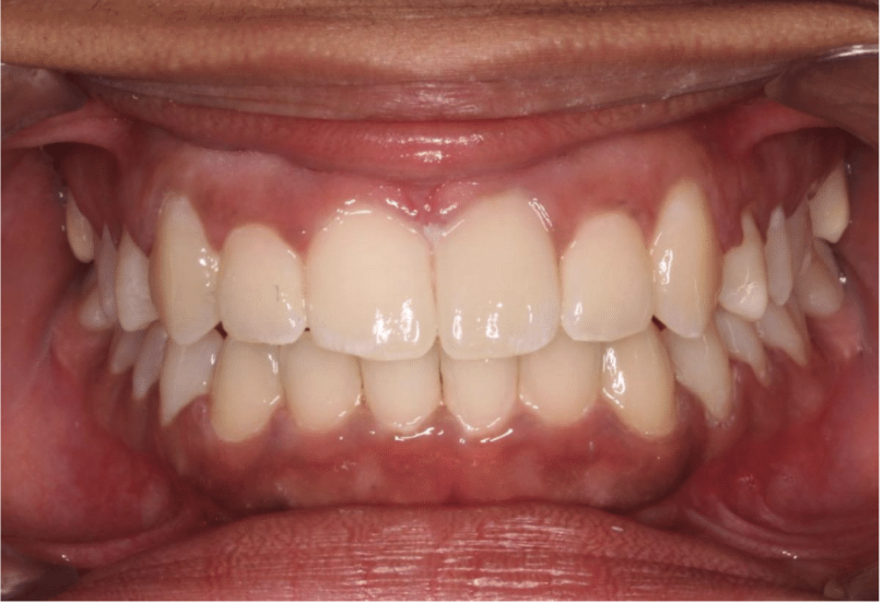 Comprehensive crowding – Patient 8 after