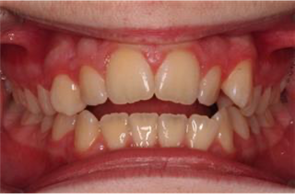 Comprehensive open bite – Patient 8 before