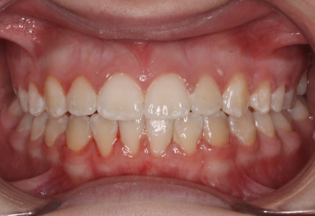 Crossbite correction – Patient 2 after