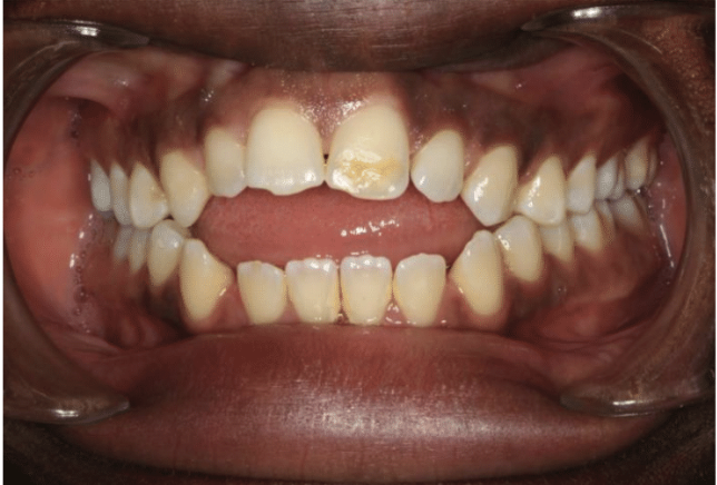 Digit habit – Patient 5 before