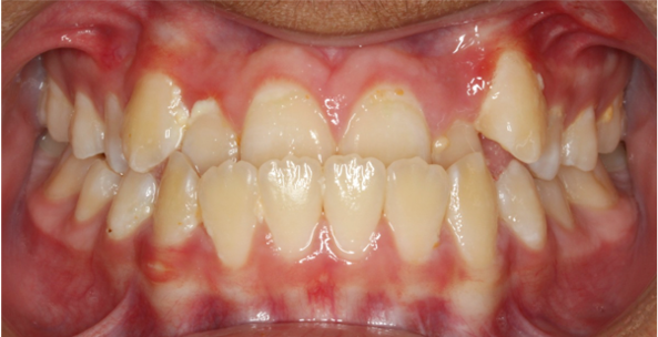 Comprehensive underbite – Patient 3 before