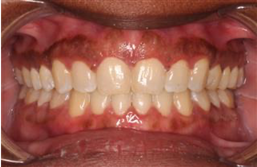 Comprehensive open bite – Patient 5 after