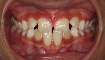 Phase I underbite – Patient 6 before