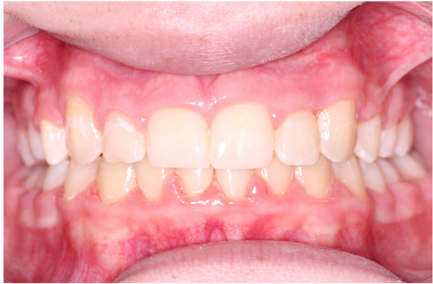 Comprehensive protrusion – Patient 7 after