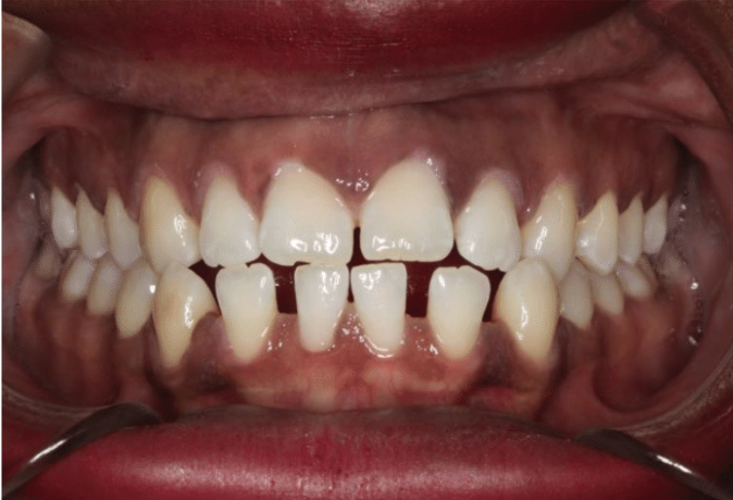 Comprehensive spacing – Patient 5 before