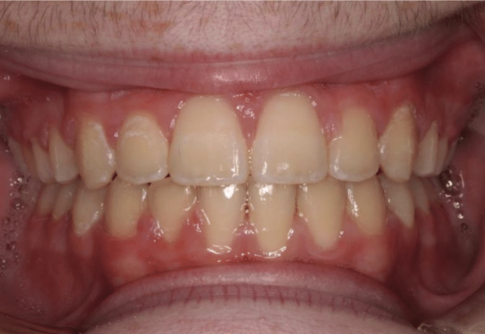 Digit habit – Patient 3 after