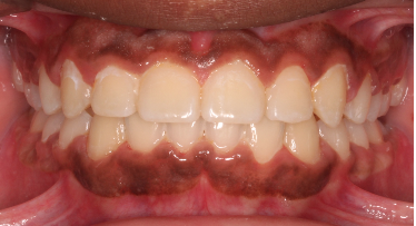 Phase I underbite – Patient 7 after