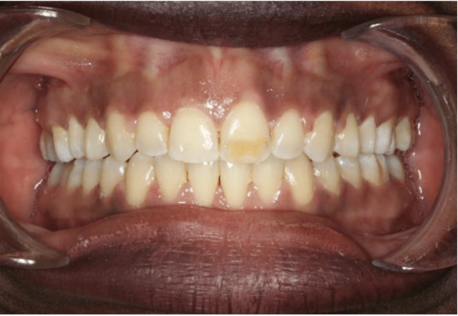 Digit habit – Patient 5 after