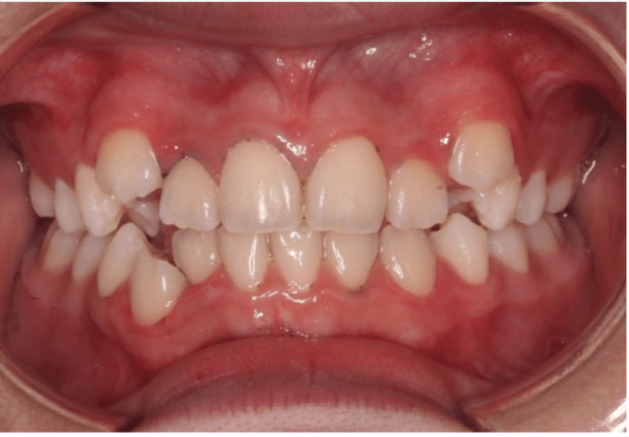 Comprehensive crowding – Patient 5 before