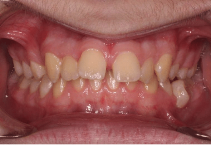 Comprehensive deep bite – Patient 3 before