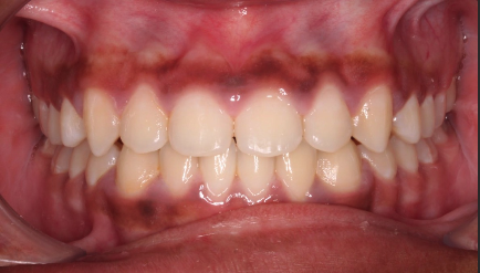 Phase I underbite – Patient 1 after