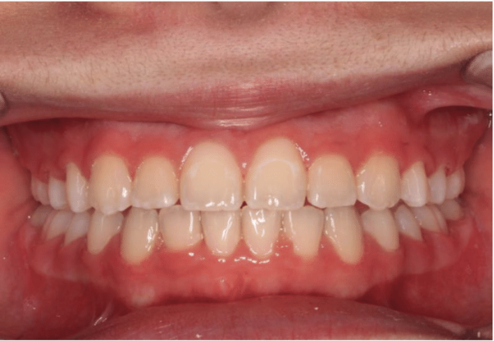 Comprehensive crowding – Patient 5 after