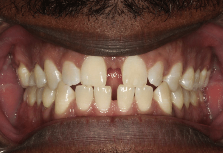 Comprehensive spacing – Patient 4 before