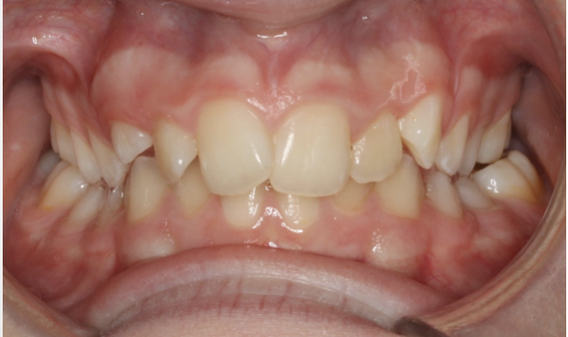 Crossbite correction – Patient 4 before