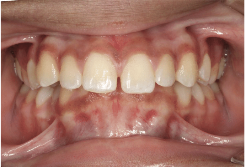 Comprehensive deep bite – Patient 7 before