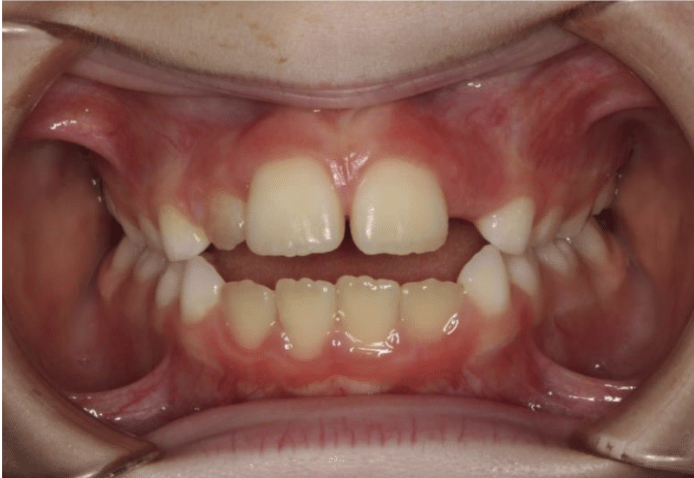 Digit habit – Patient 3 before