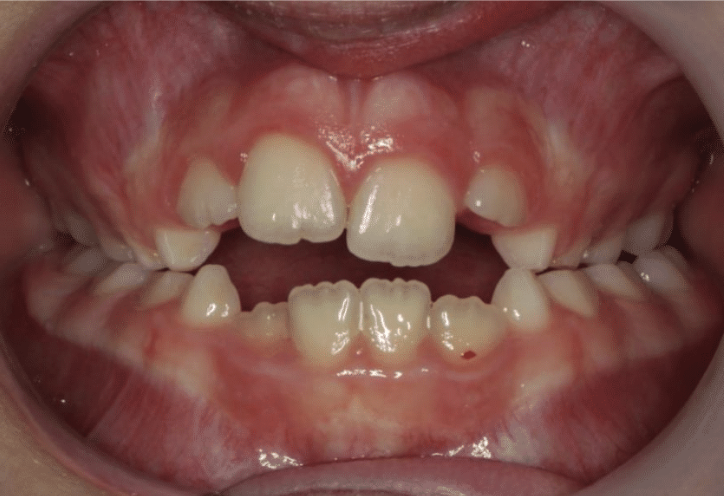 Digit habit – Patient 8 before