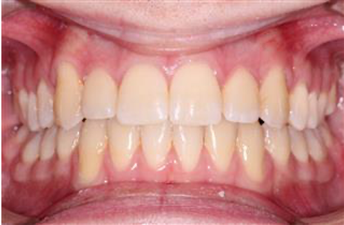 Comprehensive open bite – Patient 7 after