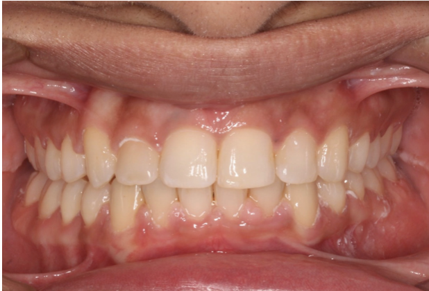 Crossbite correction – Patient 7 after
