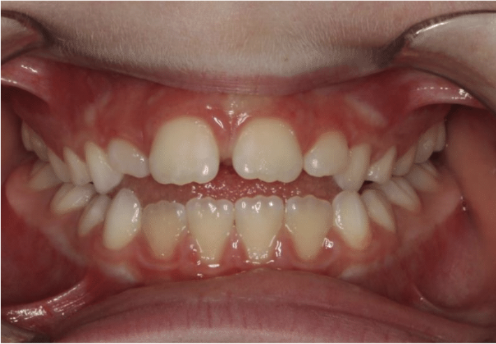 Digit habit – Patient 2 before
