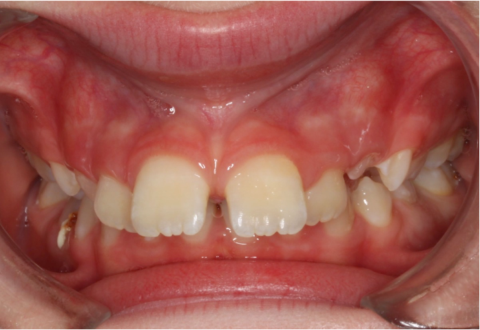 Comprehensive protrusion – Patient 3 before