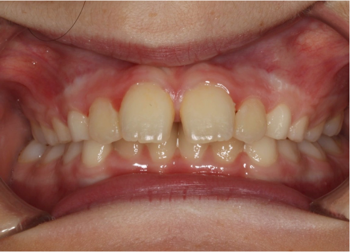 Comprehensive protrusion – Patient 6 before
