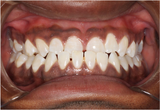 Comprehensive underbite – Patient 2 before