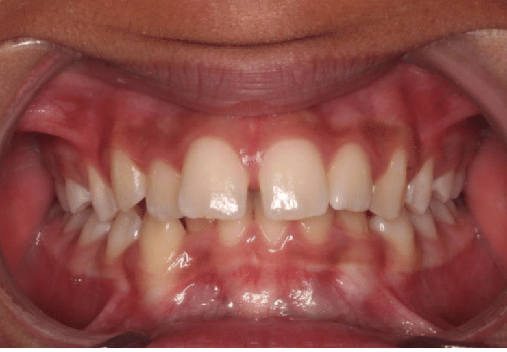 Comprehensive spacing – Patient 6 before