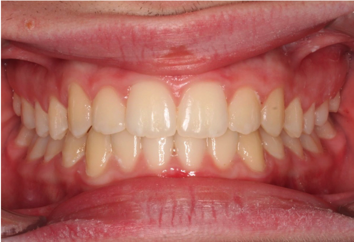 Comprehensive underbite – Patient 4 after