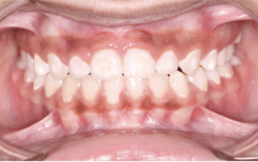 Comprehensive spacing – Patient 3 after