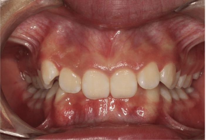 Comprehensive deep bite – Patient 5 before