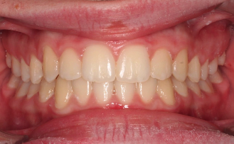 Phase I underbite – Patient 5 after
