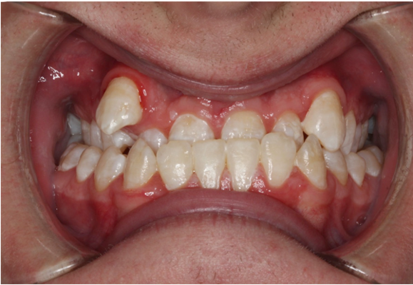 Comprehensive underbite – Patient 1 before